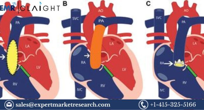 Transcatheter Pulmonary Valve Market