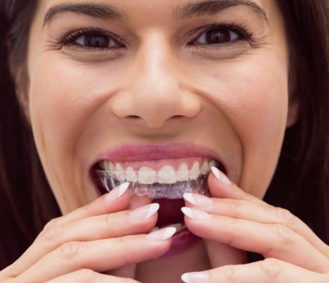 invisalign cost in ahmedabad