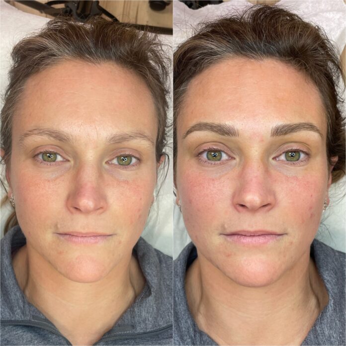 microneedling boston