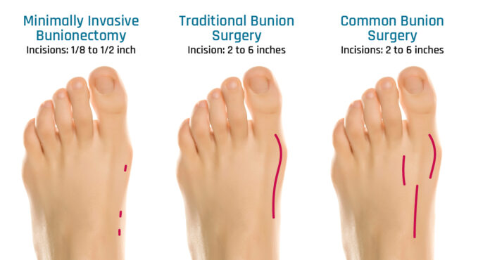 Minimally Invasive Bunion Correction