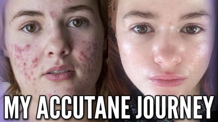 acne treatment for adults