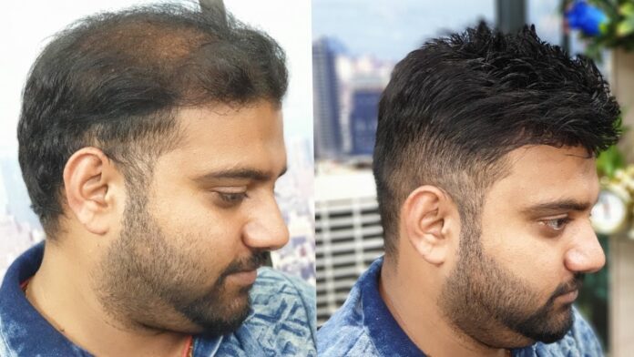 Best Hair Transplant in Islamabad